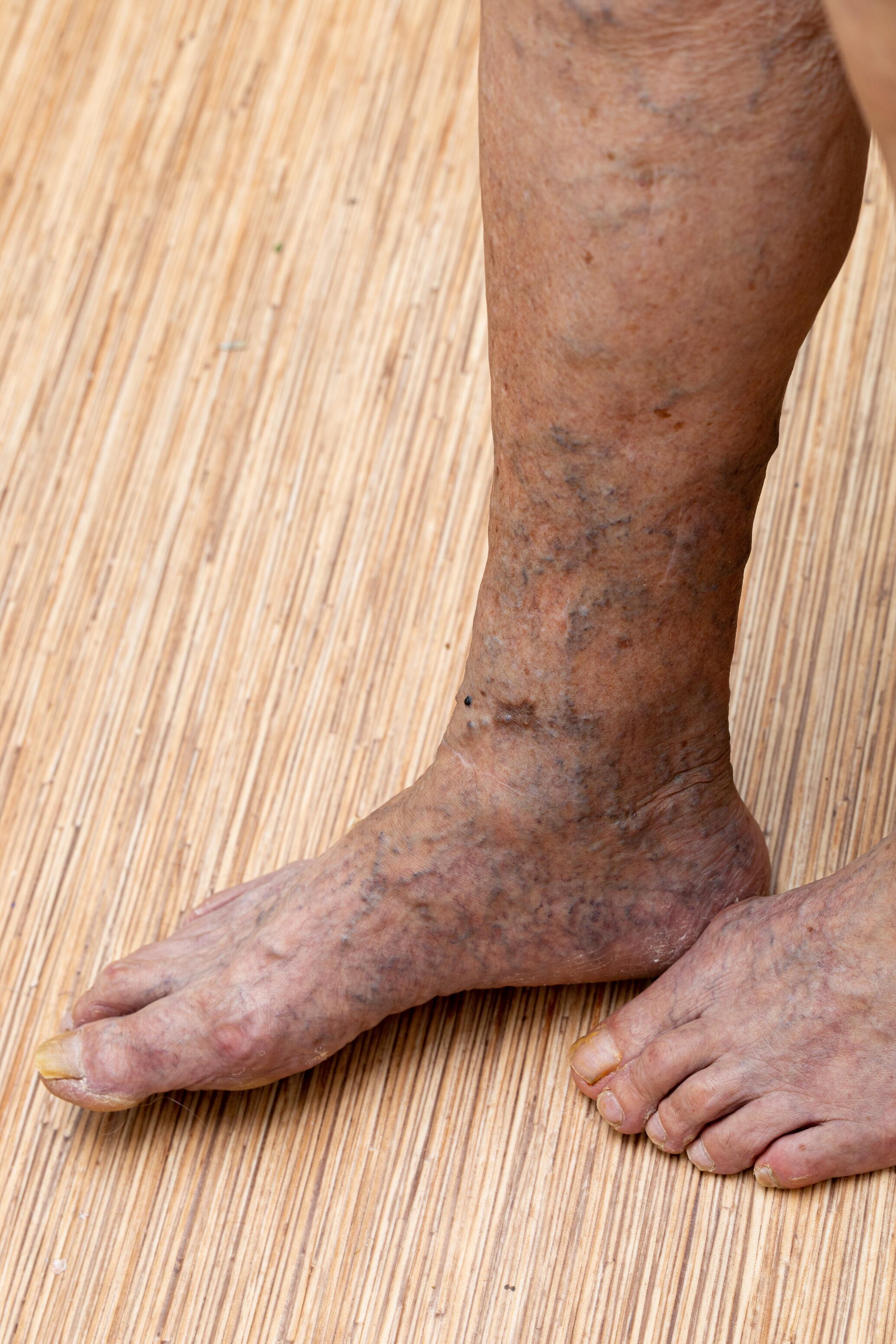 Leg with severe varicose eczema